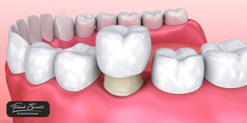 طول عمر ایمپلنت دندان و تاج پروتزی آن چقدر است؟