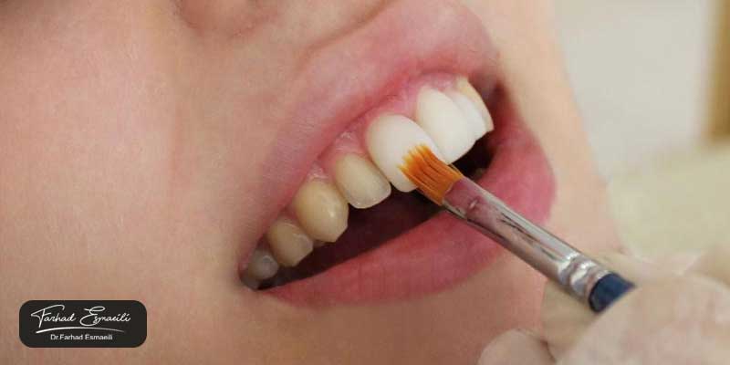 هزینه برداشتن کامپوزیت از روی دندان در اصفهان چقدر است؟