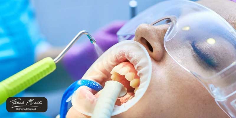 برداشتن کامپوزیت از روی دندان با Air-abrasion
