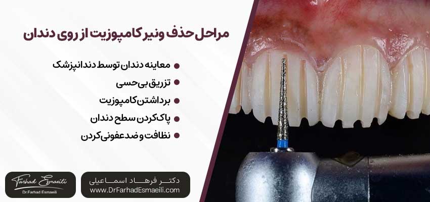 مراحل حذف ونیر کامپوزیت از روی دندان