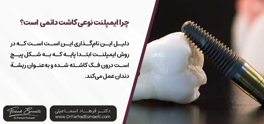 چرا ایمپلنت دندان نوعی کاشت دائمی دندان محسوب میشود؟