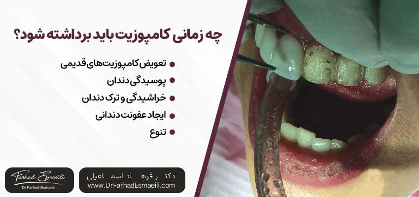 در چه مواردی کامپوزیت می‌بایست برداشته شود؟