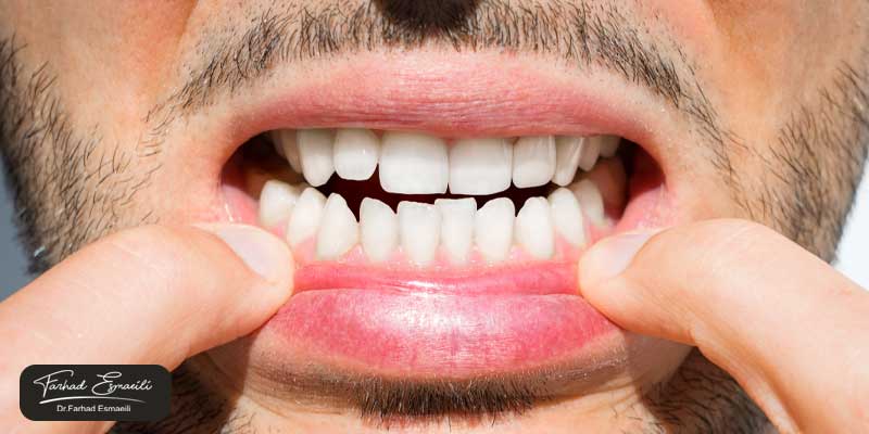 آیا دندانهای کج را میتوان کامپوزیت کرد؟