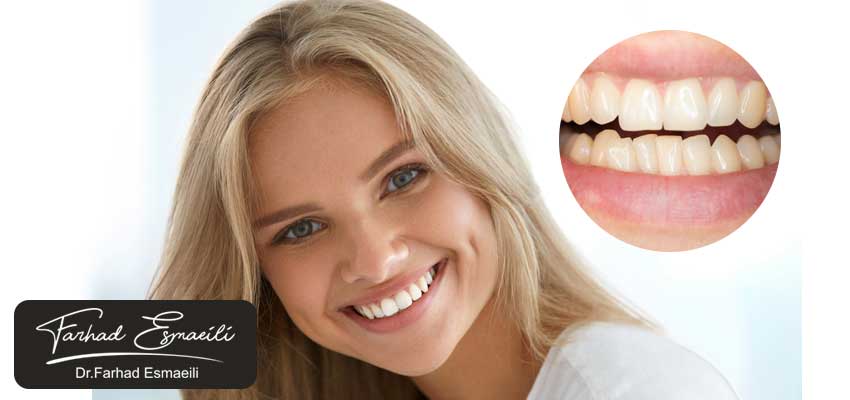 آیا دندان کج را میتوان با کامپوزیت اصلاح کرد؟