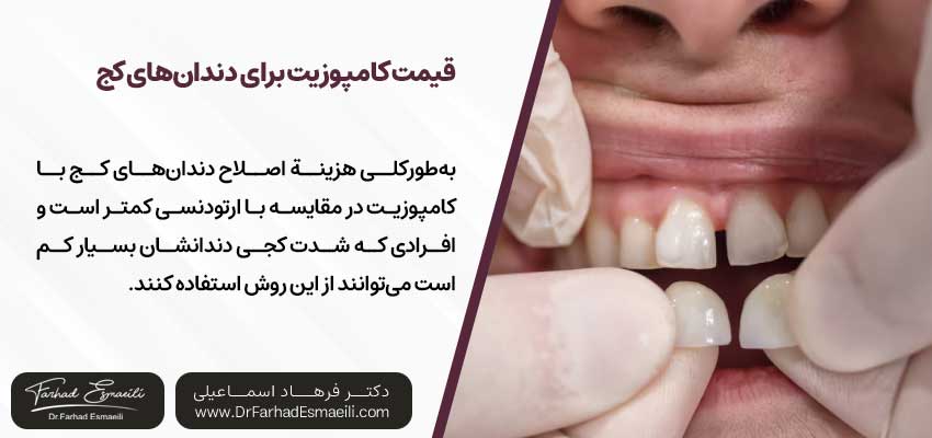 قیمت کامپوزیت برای دندانهای کج در اصفهان