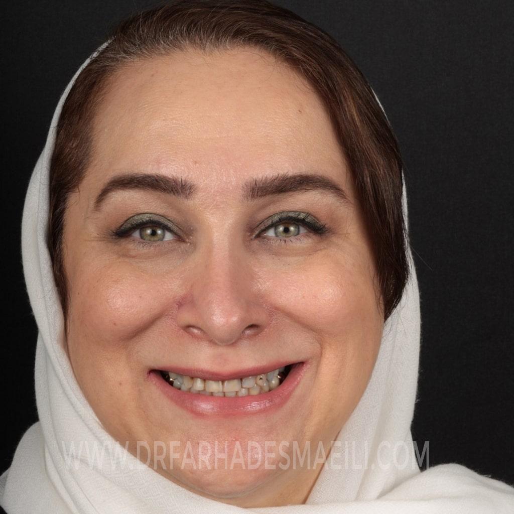 درمان ونیر کامپوزیتی با روش دندانپزشکی دیجیتال