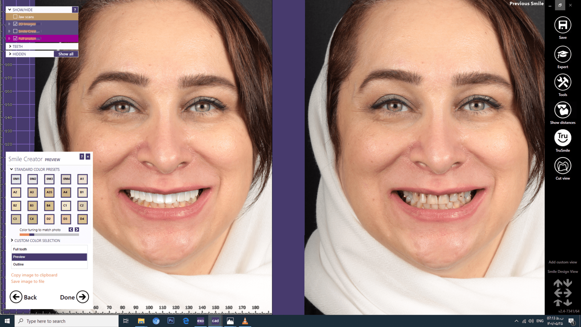 درمان ونیر کامپوزیتی با روش دندانپزشکی دیجیتال