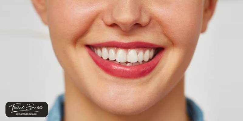 ضخامت لمینت دندان خرگوشی چقدر است؟