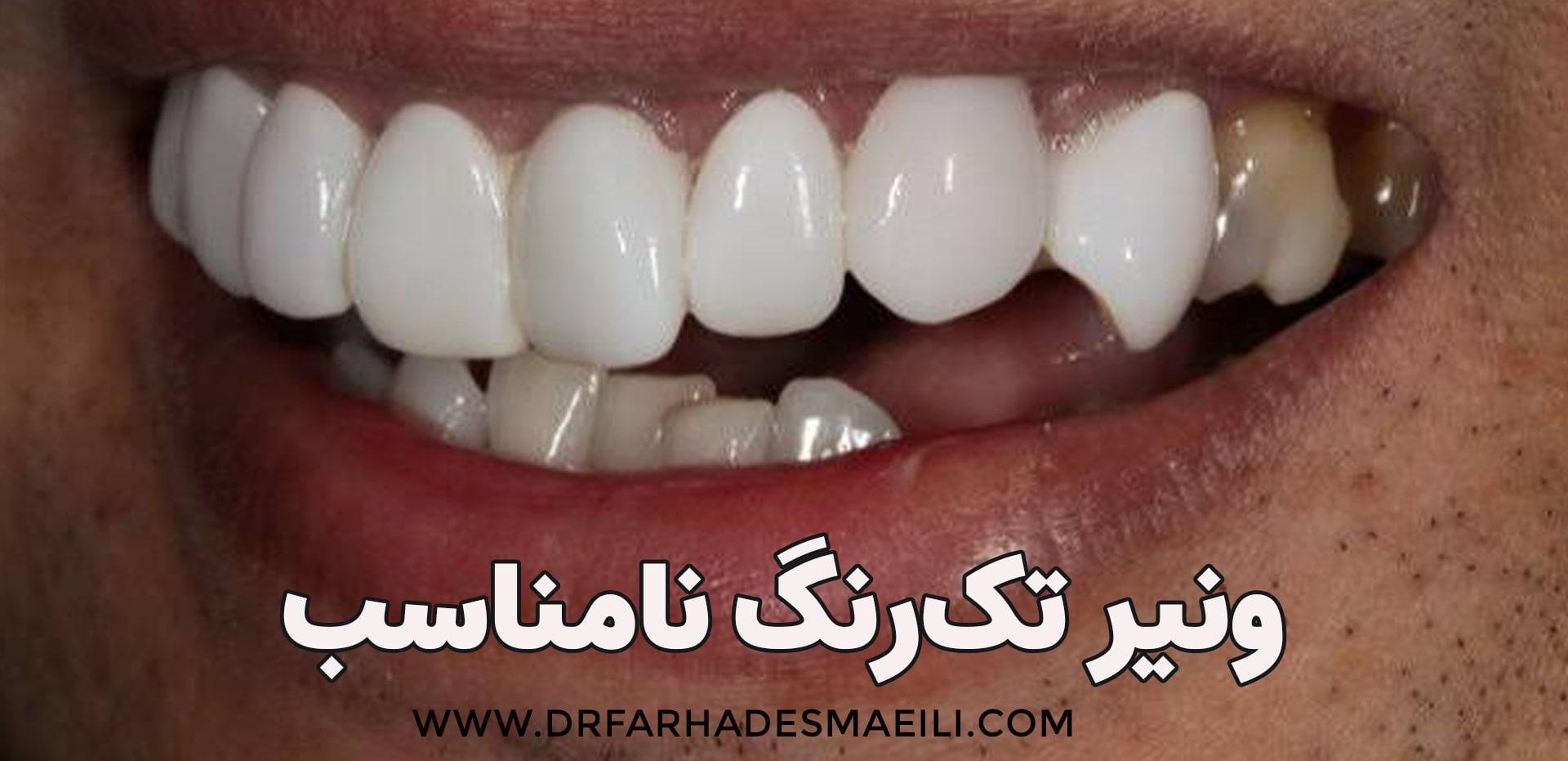 ونیر تک رنگ نامناسب