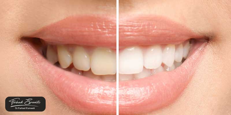طول عمر لمینت بیشتر است یا کامپوزیت؟