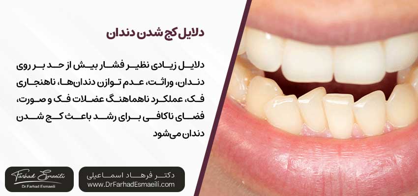 دلایل کج شدن دندان