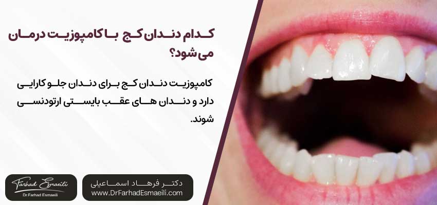 کدام دندان کج را به کمک کامپوزیت میتوان درمان کرد؟