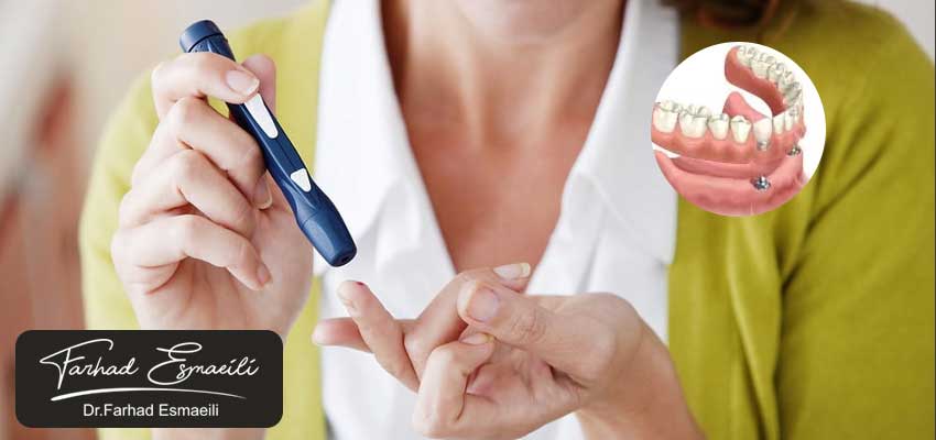 کاشت ایمپلنت برای افراد دیابتی