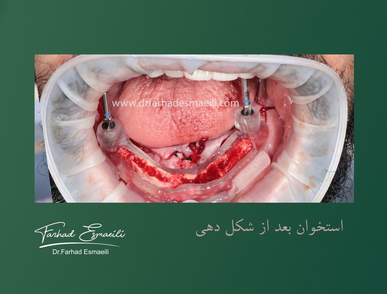 شکل‌دهی استخوان مطابق با راهنمای سطحی گاید اول