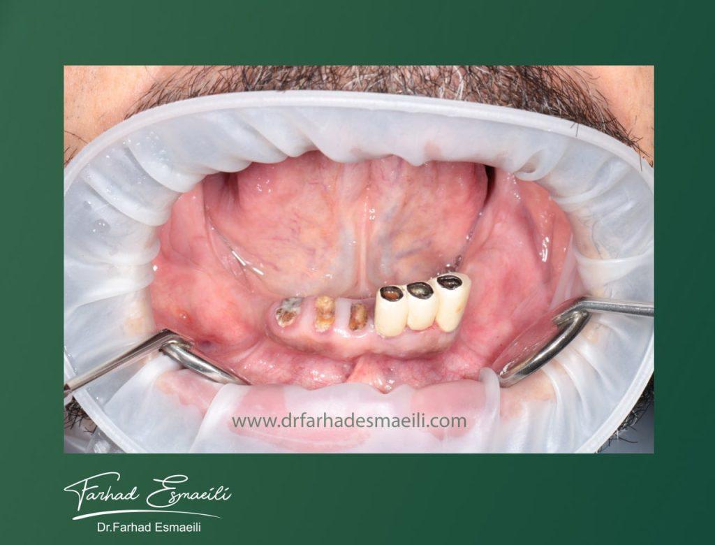 درمان بی دندانی کامل با ایمپلنت دیجیتال