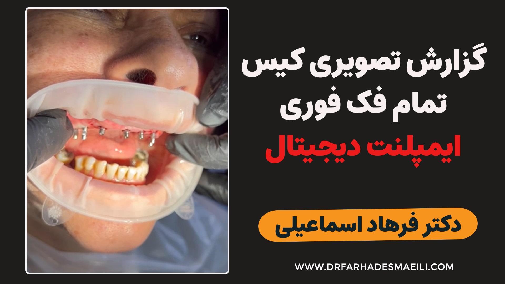 ایمپلنت تمام فک دیجیتال در اصفهان