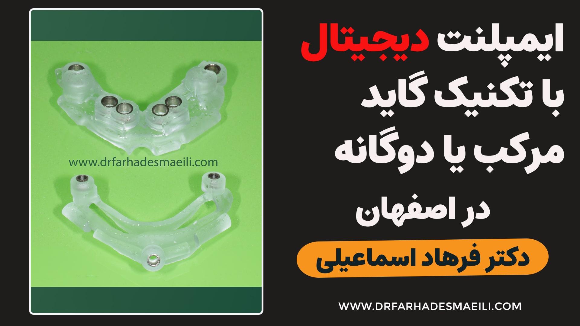 درمان یک بیمار بی دندان با روش ایمپلنت دیجیتال همراه با تکنیک گاید مرکب