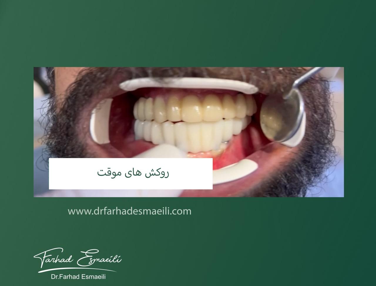 آزموده شد همه چیز با متریال موقت (PMMA)