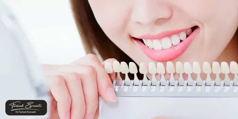 پرطرفدارترین رنگ کامپوزیت دندان در اصفهان چیست؟