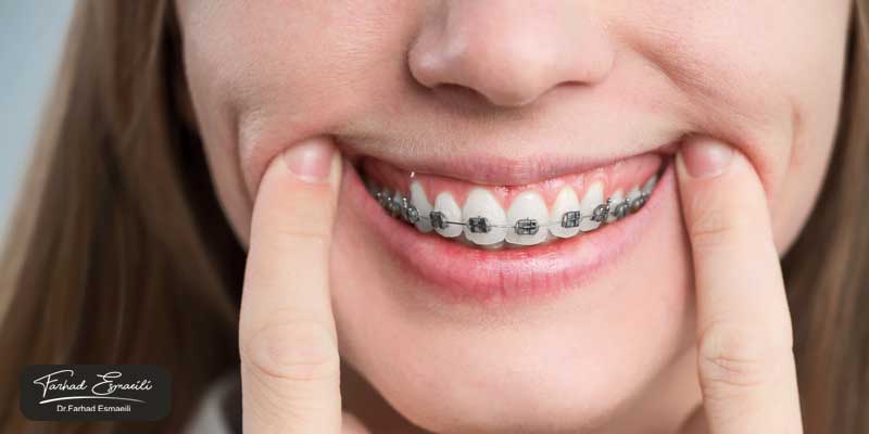 آیا بعد از ایمپلنت میتوان ارتودنسی کرد؟