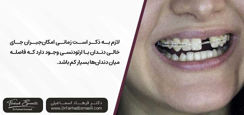 در صورت از دست دادن چند دندان آیا امکان استفاده از ارتودنسی وجود دارد؟