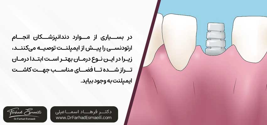 ارتودنسی قبل از ایمپلنت