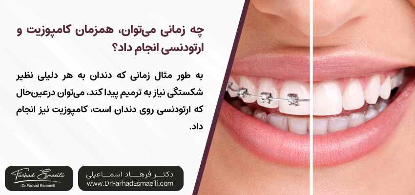 چه زمانی میتوان، همزمان کامپوزیت و ارتودنسی انجام داد؟