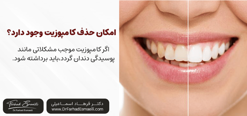 امکان حذف کامپوزیت وجود دارد؟