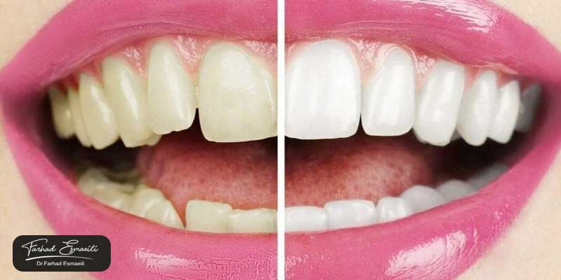 بلیچینگ دندانها در خانه برای چه کسانی مؤثر است؟
