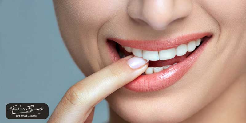 آیا نتیجه بلیچینگ خانگی دائمی است؟