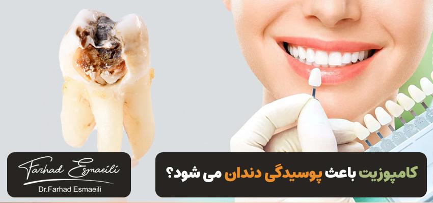 آیا کامپوزیت باعث پوسیدگی دندان می شود؟ | عوارض خطرناک | دکتر فرهاد اسماعیلی