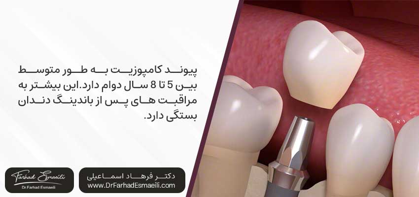 پیوند کامپوزیت چقدر دوام دارد؟