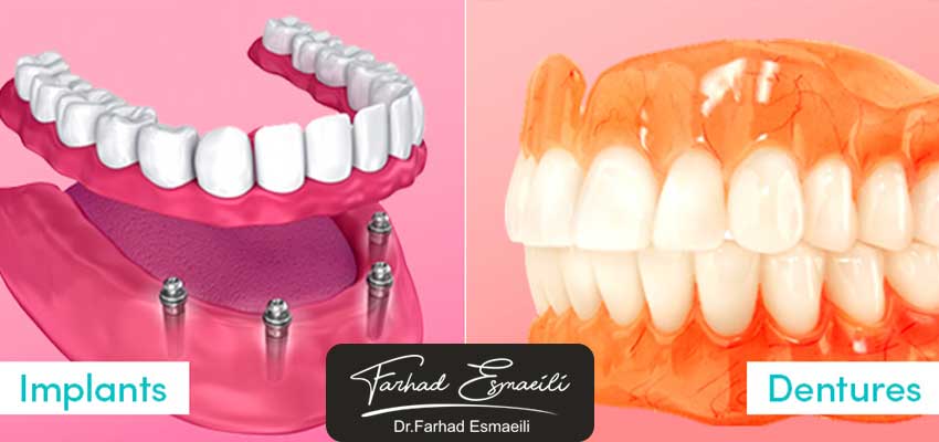 ایمپلنت یا دندان مصنوعی،کدام بهتر است؟