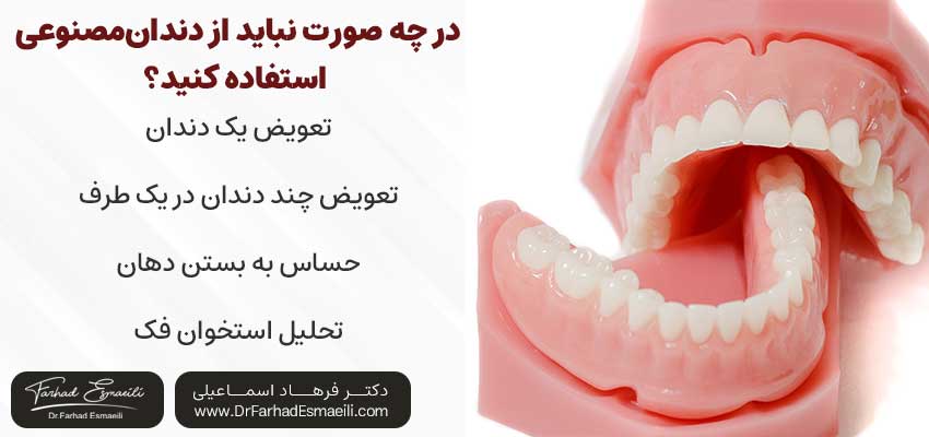 ایمپلنت یا دندان مصنوعی،کدام بهتر است؟