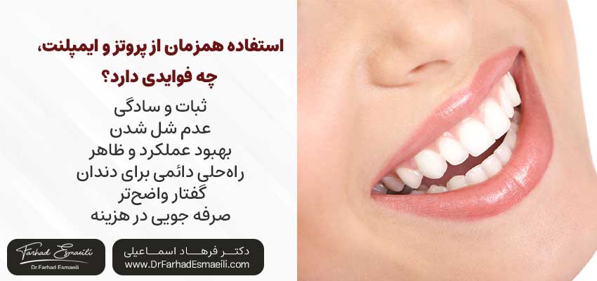 استفاده همزمان از پروتز و ایمپلنت،چه فوایدی دارد؟