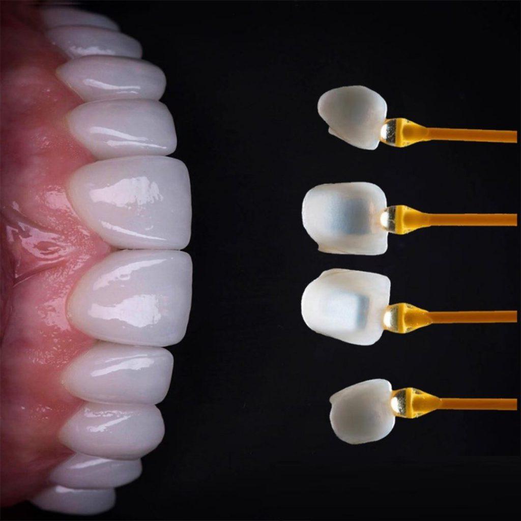روکش های دندان | مطب دندانپزشکی دکتر فرهاد اسماعیلی
