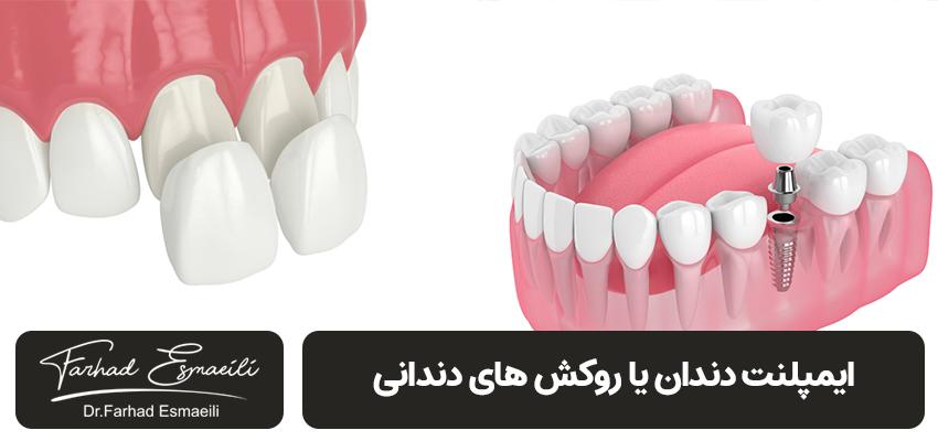 ایمپلنت بهتر است یا لمینت سرامیکی ایمپلنت بهتر است یا کامپوزیت دندان | مطب دکتر فرهاد اسماعیلی