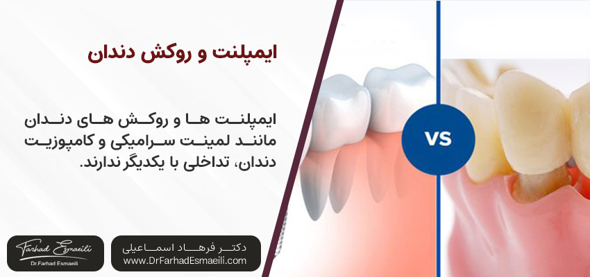 دندان ایمپلنت همراه با روکش لمینت | دکتر فرهاد اسماعیلی دندانپزشک اصفهان
