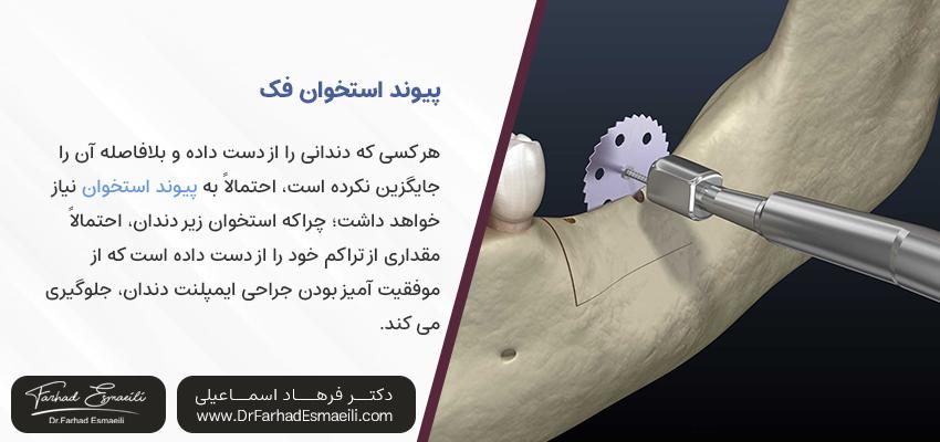 پیوند استخوان دهان قبل از ایمپلنت | مرکز تخصصی ایمپلنت دندان اصفهان