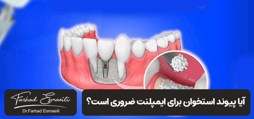 پیوند استخوان قبل از ایمپلنت | مرکز ایمپلنت دیجیتا اصفهان