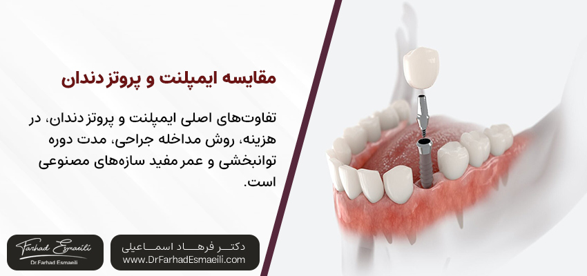 مقایسه ایمپلنت و پروتز دندان | مطب دندانپزشکی دکتر فرهاد اسماعیلی در اصفهان