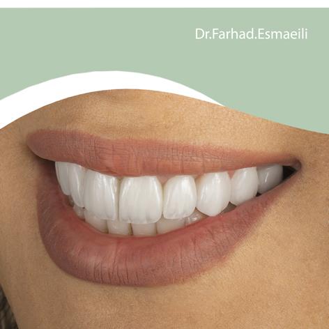 لمینیت سرامیکی دیجیتال در اصفهان