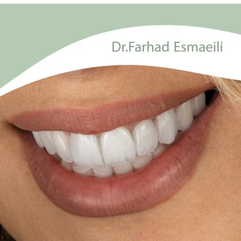 لمینیت سرامیکی دیجیتال در اصفهان