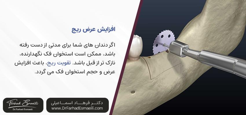 افزایش عرض ریج | مرکز دندانپزشکی دیجیتال دکتر فرهاد اسماعیلی در اصفهان