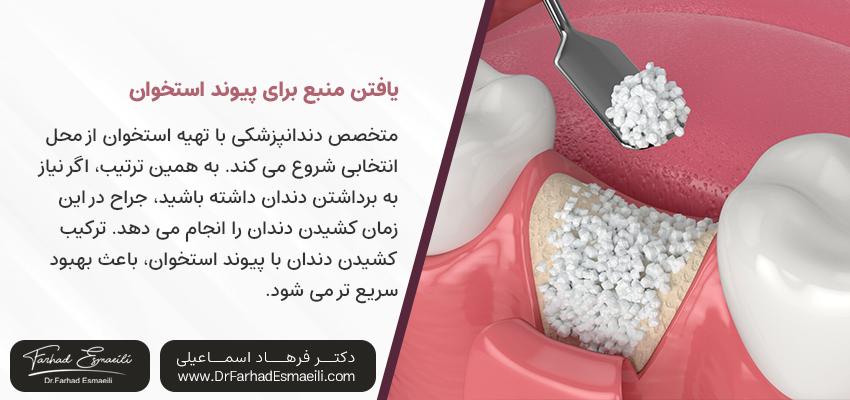 مراحل پیوند استخوان | مرکز ایمپلنت دیجیتال اصفهان