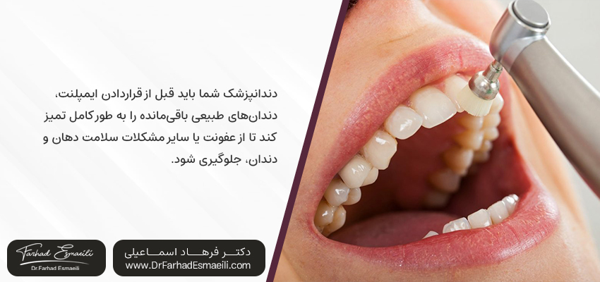 تمیز کردن دندان قبل از ایمپلنت دندان | چرا قیمت ایمپلنت اینقدر گران است؟