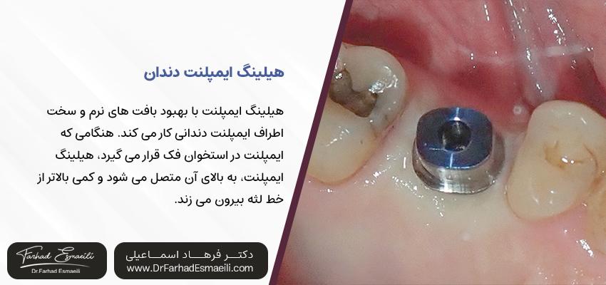 کلاهک هیلینگ ایمپلنت دندان | مرکز تخصصی ایمپلنت دیجیتال اصفهان