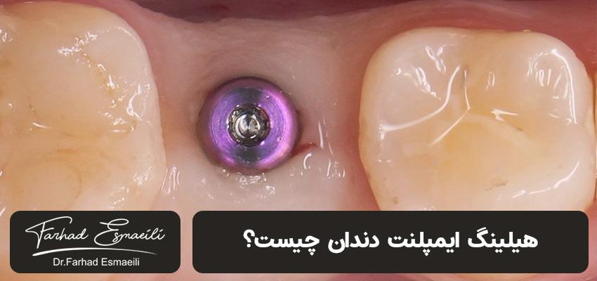 کلاهک هیلینگ ایمپلنت دندان | مطب دکتر فرهاد اسماعیلی