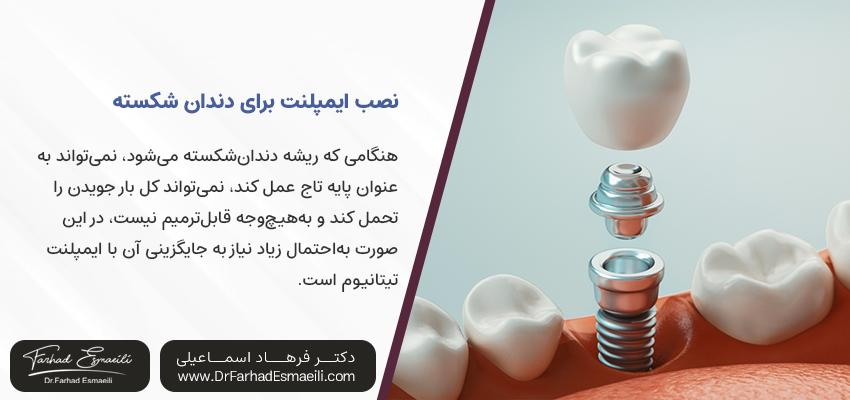 نصب ایمپلنت دندان | مرکز تخصصی ایمپلنت دکتر فرهاد اسماعیلی