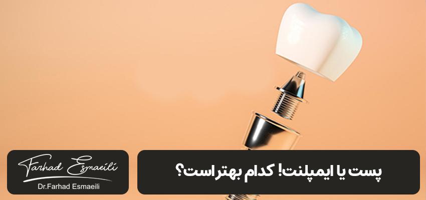 پست دندان | بهترین متخصص ایمپلنت ایران